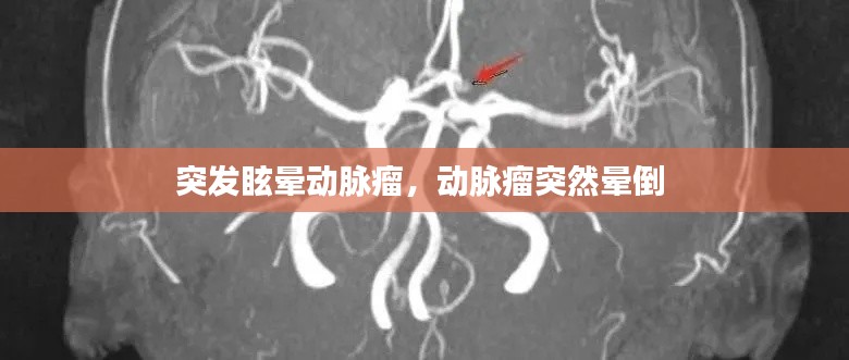 突发眩晕动脉瘤,动脉瘤突然晕倒